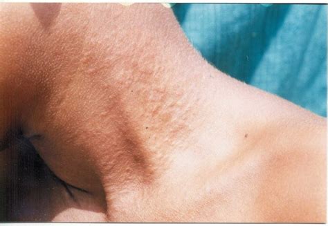 Some Common And Dangerous Diseases Of The Skin