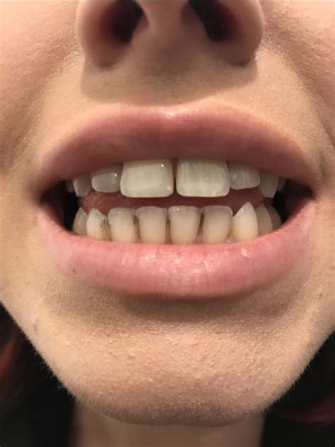 Whats This Black Stuff On My Teeth Glow Community