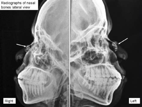 Nasal Bones X Ray Labeled Sexiz Pix