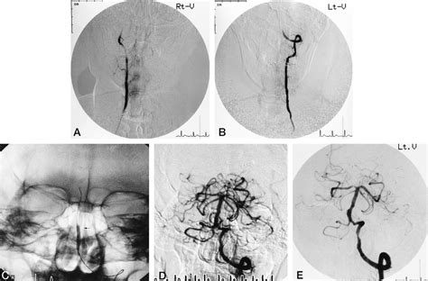 60 Year Old Man With Persistence Of Dysarthria Dysphasia Trunk