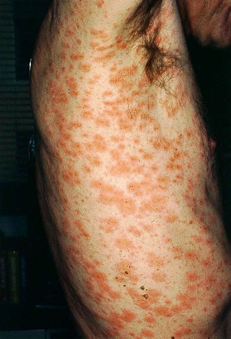 Pityriasis Rosea Treatment Causes Stages Pictures And Herpes