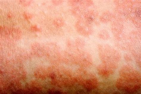 Scarlet Fever Cases Have Hit Worrying New Record Levels In Kent Kent Live