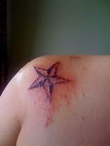 Henna Tattoo Allergy Treatment Photos