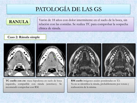 Ppt Patología De Las Glándulas Salivales Hecha Fácil Powerpoint