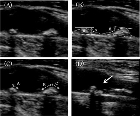 Plaque Surface Irregularity And Calcification Length Within Carotid
