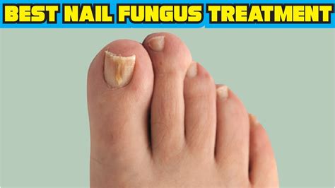 Top 5 Best Nail Fungus Treatment Reviews Youtube