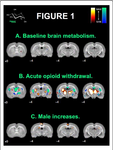 Figure 1 From Imaging Sex Differences In Regional Brain Metabolism During Acute Opioid