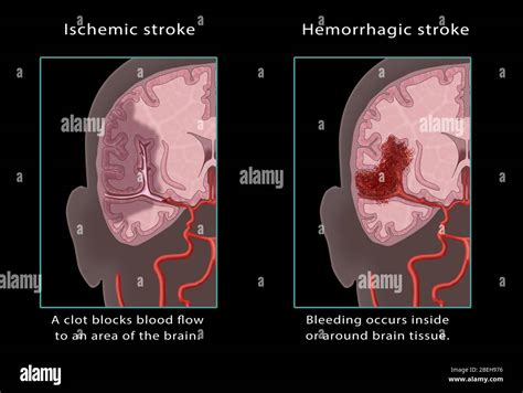 Ischemic And Hemorrhagic Stroke Illustration Stock Photo Alamy