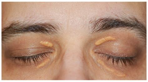 Understanding Xanthelasma The Weird Yellow Deposits On Your Eyelids