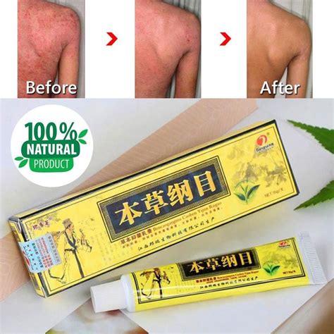 Original Advanced Psoriasis And Eczema Natural Herbal Cream Eczema