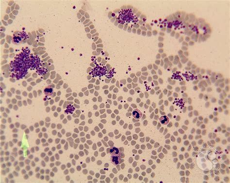 Platelet Clump In Peripheral Blood Smear