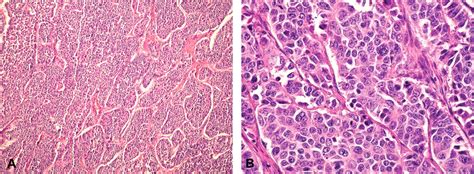Hgh And Ghr Expression In Large Cell Neuroendocrine Carcinoma Of The