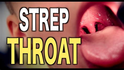 Strep Throat Live Diagnosis Youtube