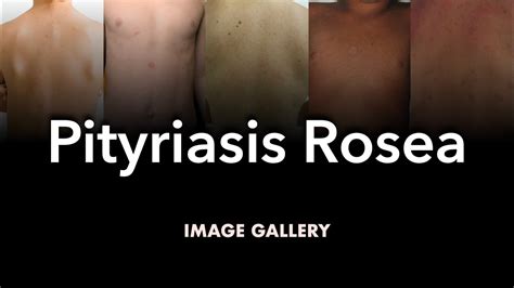 Pityriasis Rosea Image Gallery Youtube