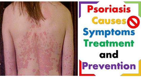 What Is Psoriasis Causes Symptoms Treatment And Prevention Youtube