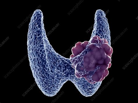 Thyroid Tumour Illustration Stock Image F0276386 Science Photo