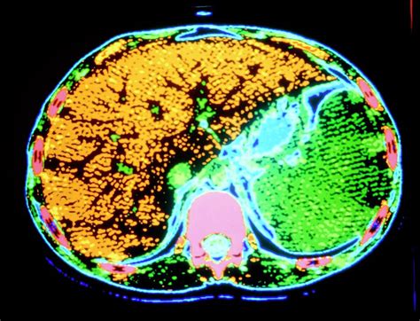 Coloured Ct Scan Showing Enlarged Spleen Photograph By