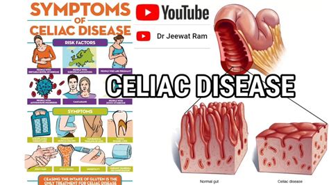 Celiac Disease Introduction Causes Signssymptoms Diagnosis And