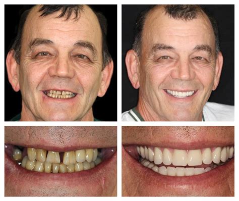Dental Implant Before And Afters Archives Ace Dental London W1