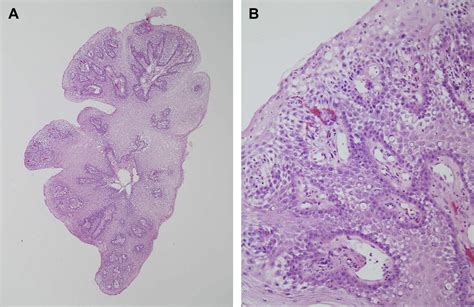 Squamous Dysplasia And Other Precursor Lesions Related To Esophageal