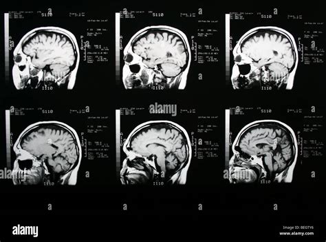 Mri Scan Of Patients Brain With And Without Contrast Agent Stock Photo