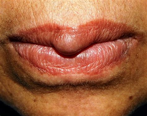 Angioleiomyoma Of The Upper Lip Bmj Case Reports