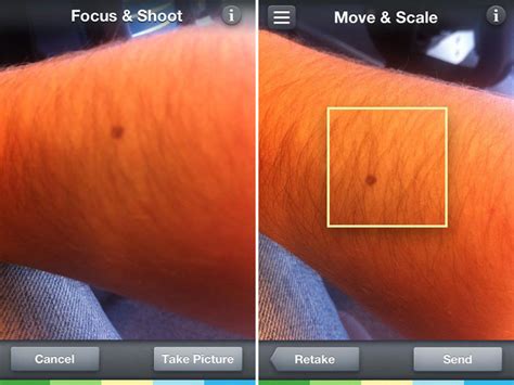 Skinvision App Turns Your Smartphone Into A Skin Cancer Scanner Bit