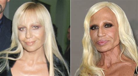 Donatella Versace Plastic Surgery Gone Bad