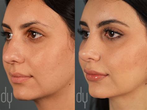 Beverly Hills Rhinoplasty Specialist Dr Donald Yoo Performed A Primary Rhinoplasty This Before