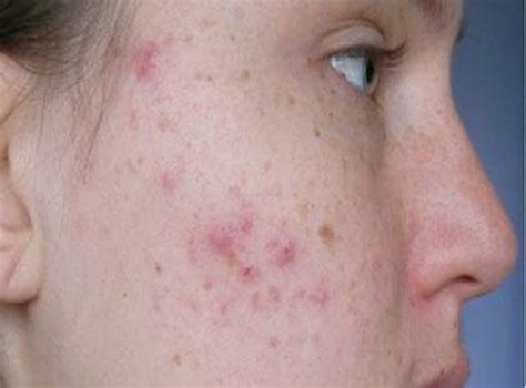 Roaccutane How Controversial Acne Wonder Drug Linked To Suicide