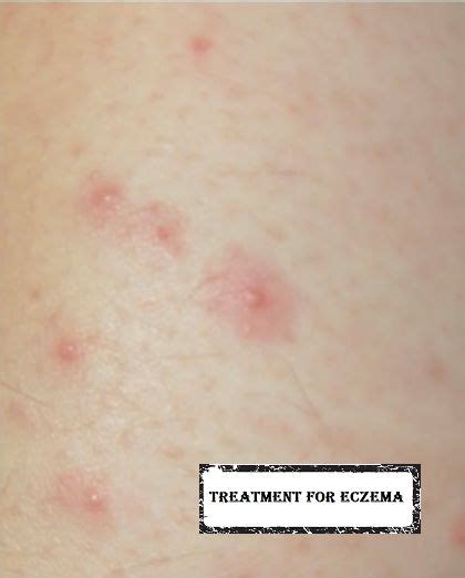 Dermatitis Herpetiformis Celiac Disease Dermatitis Herpetiformis
