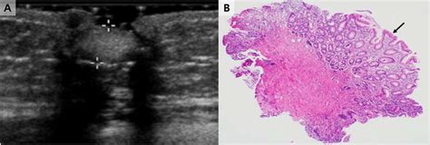 An Umbilical Polyp In An 11 Month Old Girl A Transverse Download