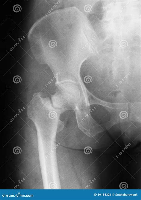X Ray Image Of Hip Joint Ap View Preoperative Stock Photo Image