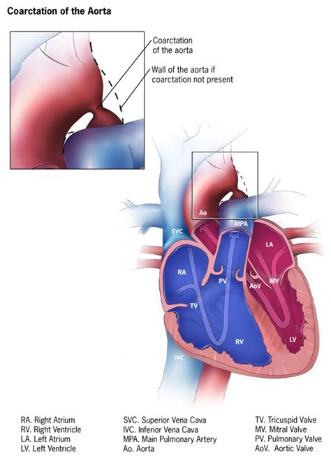 Facts About Coarctation Of The Aorta Congenital Heart Defects