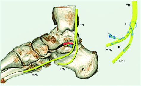 Artistic Rendering Of The Anatomy Of The Tarsal Tunnel Degenerative