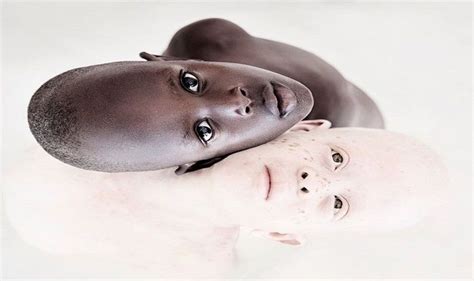 International Albinism Awareness Day Common Myths Surrounding