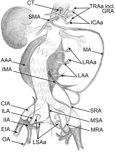 Abdominal Aorta And Iliac Arteries With Branches Involved In Spinal
