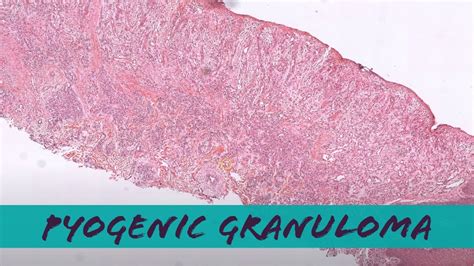 Pyogenic Granuloma Under The Microscope Lobular Capillary Hemangioma