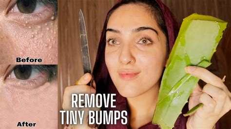 How To Remove Tiny Bumps On Your Face Theyre Not Acne Milia Youtube