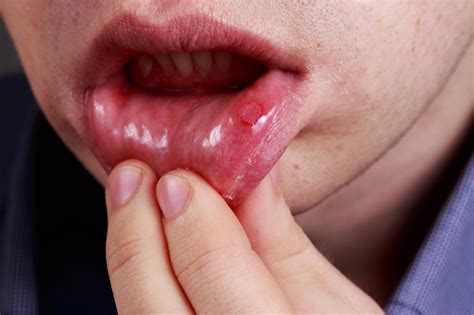 Cold Sores Vs Canker Sores Their Causes And Fivewondrous