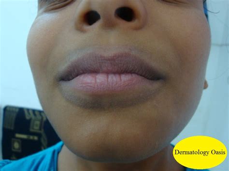 Lip Lick Dermatitis Dermatology Oasis