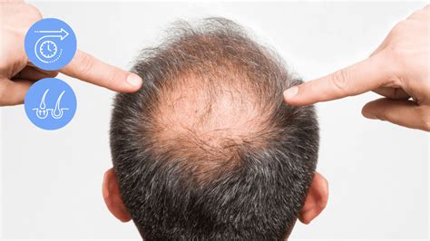 Who Should And Shouldnt Get A Hair Transplant In