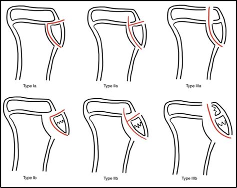 Tibial Tubercle Avulsion Fractures In Adolescents A Narrative Review