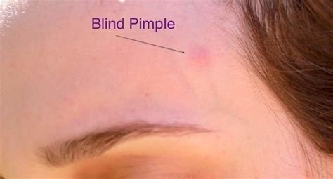 Fresh 65 Of Blind Pimple Causes A Zwildlife