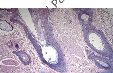 Figure 1 From Comparative Clinical And Histopathological Study On
