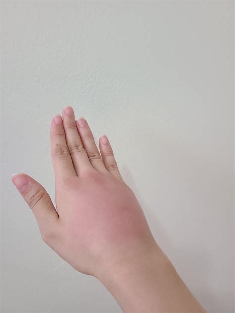 Hand Swollen From Bug Bite At The Park Last Night Likely A Mosquito