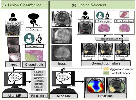 A Review Of Artificial Intelligence In Prostate Cancer Detection On Imaging Indrani