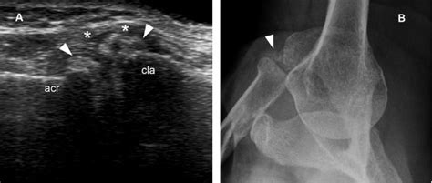 Acromioclavicular Joint Radiology Key