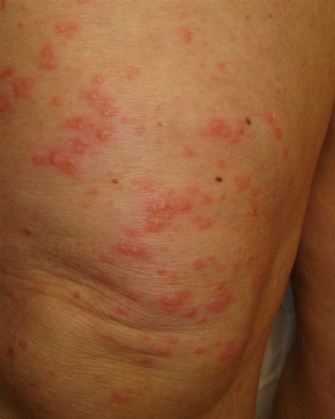 Dermatitis Herpetiformis Scalp