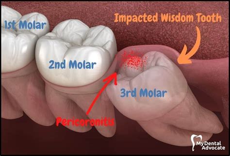 Impacted Wisdom Teeth Symptoms Causes Removal And Recovery